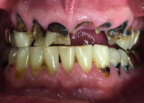 Meth Mouth - signs of a Meth addiction